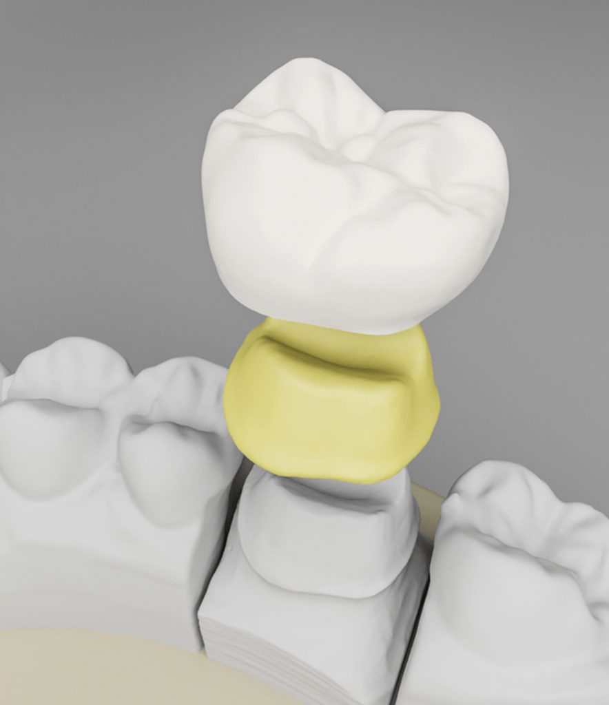 köprü ve implant