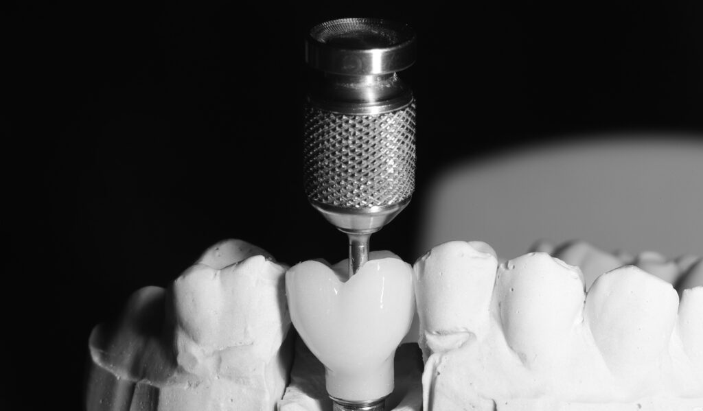 dental implant